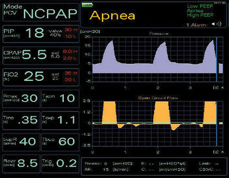 Neonatal Ventilator